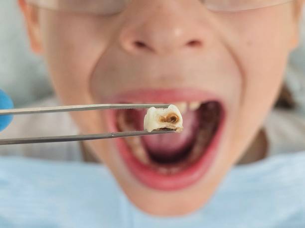 Best Emergency Tooth Extraction in Mount Gilead, OH