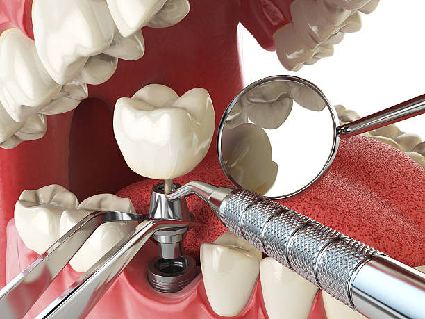 Best Emergency Treatment for Dental Infections or Abscesses in Mount Gilead, OH